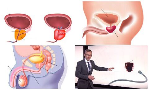 prostată sănătoasă și bolnavă