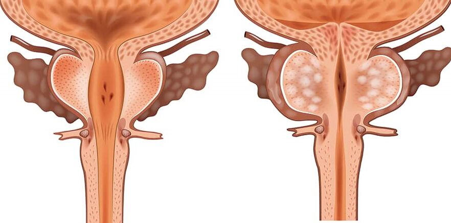 Inflamație latentă a prostatitei cronice a gardnerelozei, Inflamație articulară din ureaplasmoză